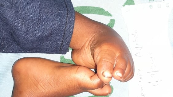 Clubfoot Patients Gets Free Comprehensive Treatment In Federal Medical Center, Lokoja